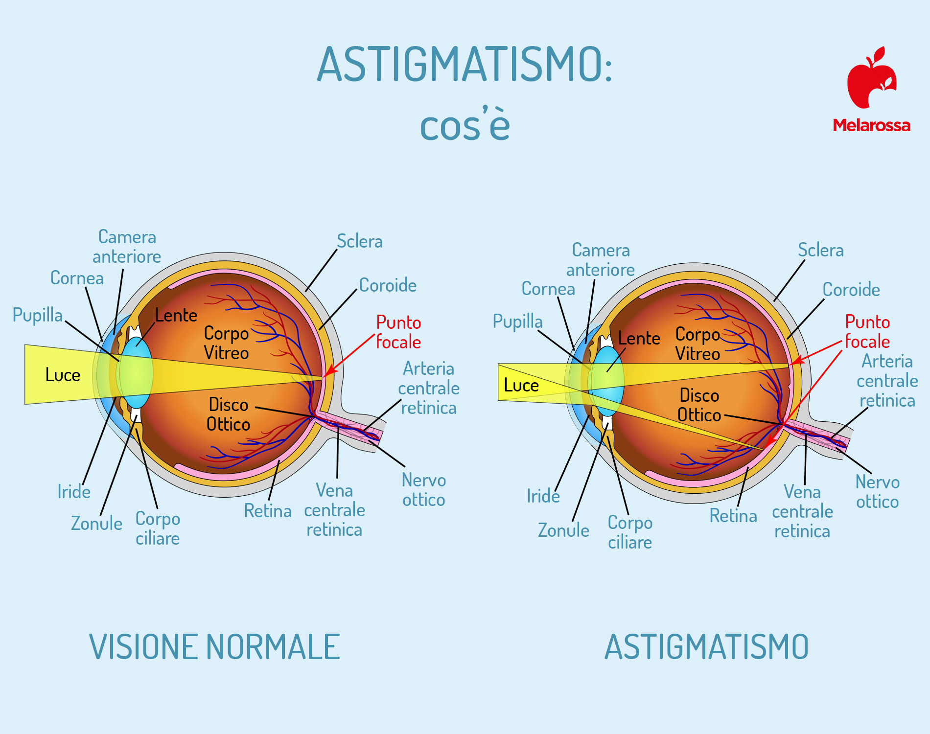 Astigmatismo: cos'è, cause, sintomi, diagnosi e cure 1 astigmatismo: anatomia dell'occhio