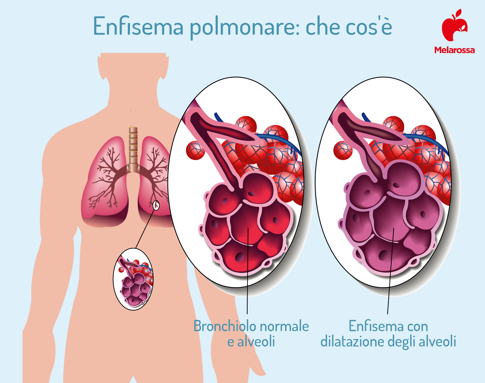 Enfisema polmonare: cos'è, cause, sintomi e cure 1 enfisema polmonare: che cos'è