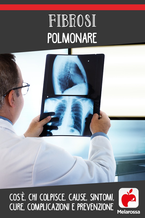 Fibrosi polmonare: cos'è, chi colpisce, cause, sintomi, cure, complicazioni e prevenzione 12 fibrosi polmonare: cos'è, cause, sintomi, cura e prevenzione