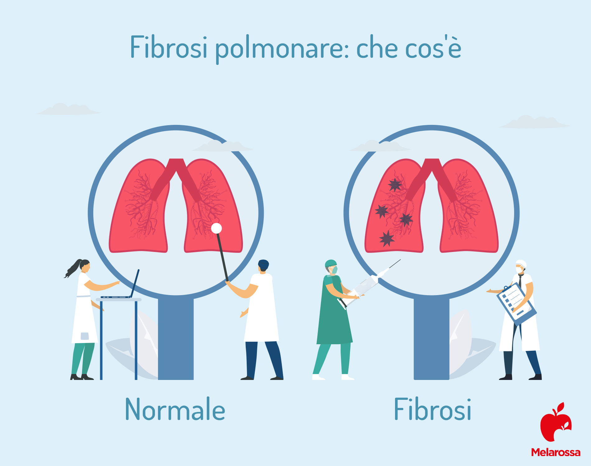 Fibrosi polmonare: cos'è, chi colpisce, cause, sintomi, cure, complicazioni e prevenzione 1 fibrosi polmonare: cos'è