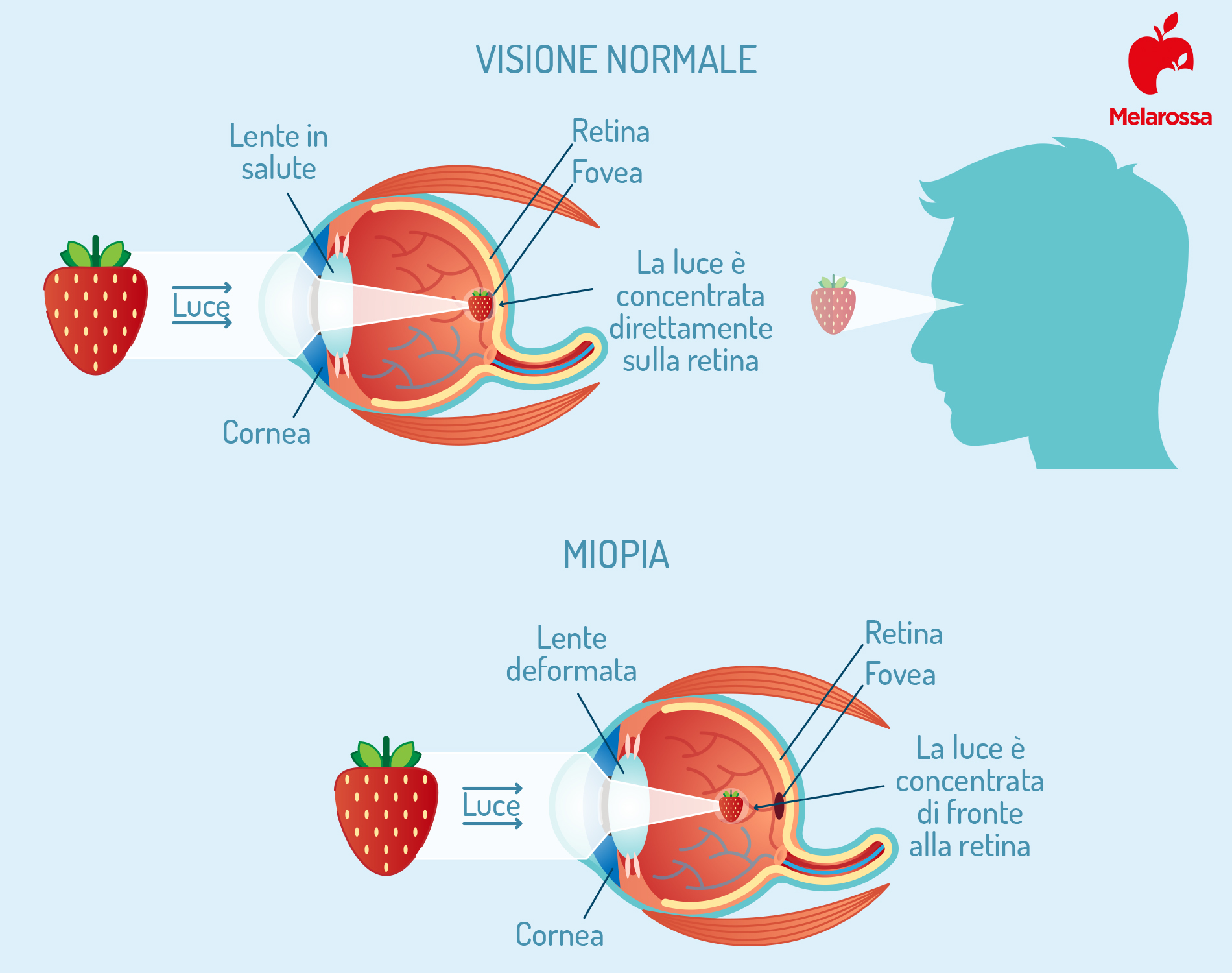 Miopia: cos’è, classificazione, cause, sintomi e cure 2 miopia: caratteristiche