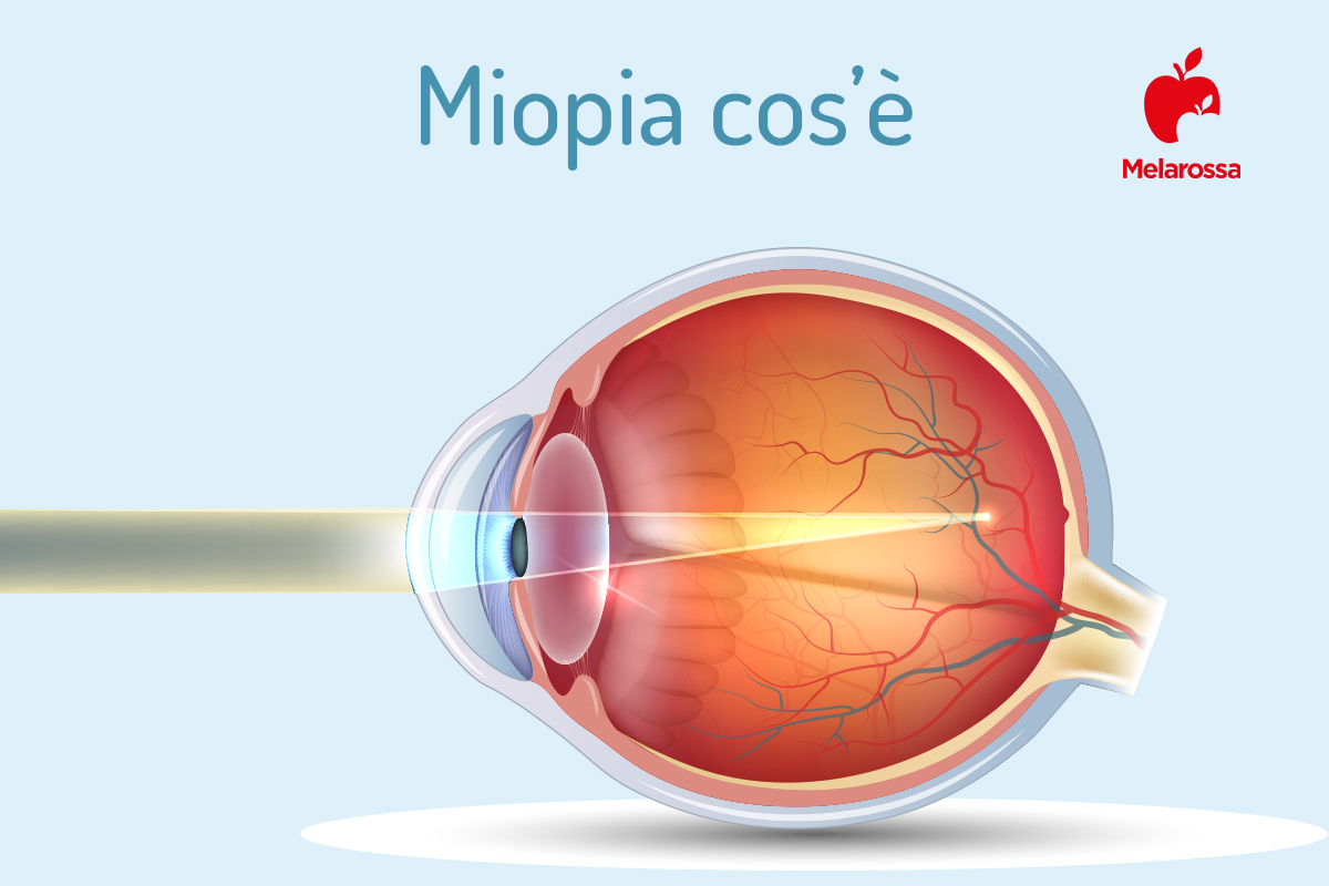 Miopia: cos’è, classificazione, cause, sintomi e cure 1 miopia: cos'è