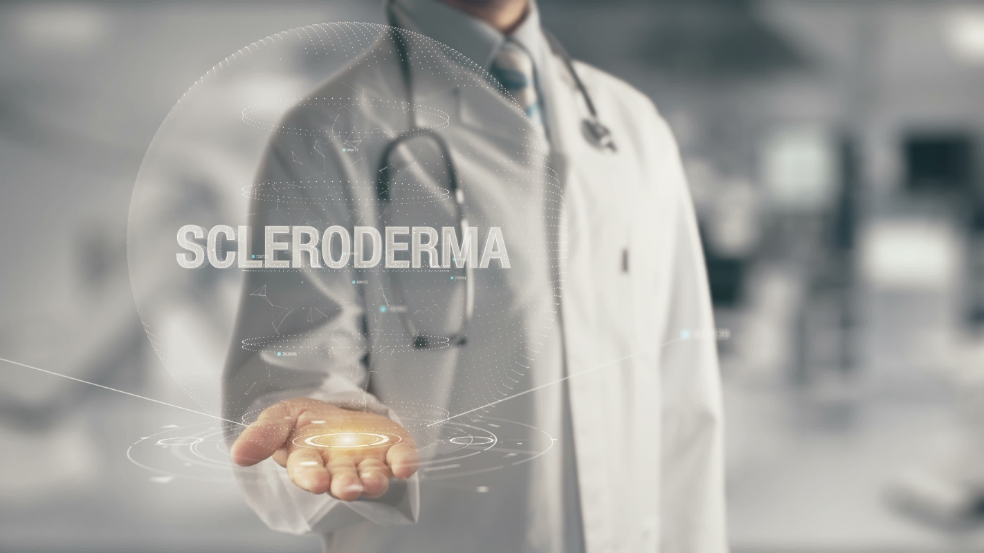 Sclerodermia: cos’è, cause, sintomi, tipi, cure e prevenzione 2 sclerodermia: epidemiologia
