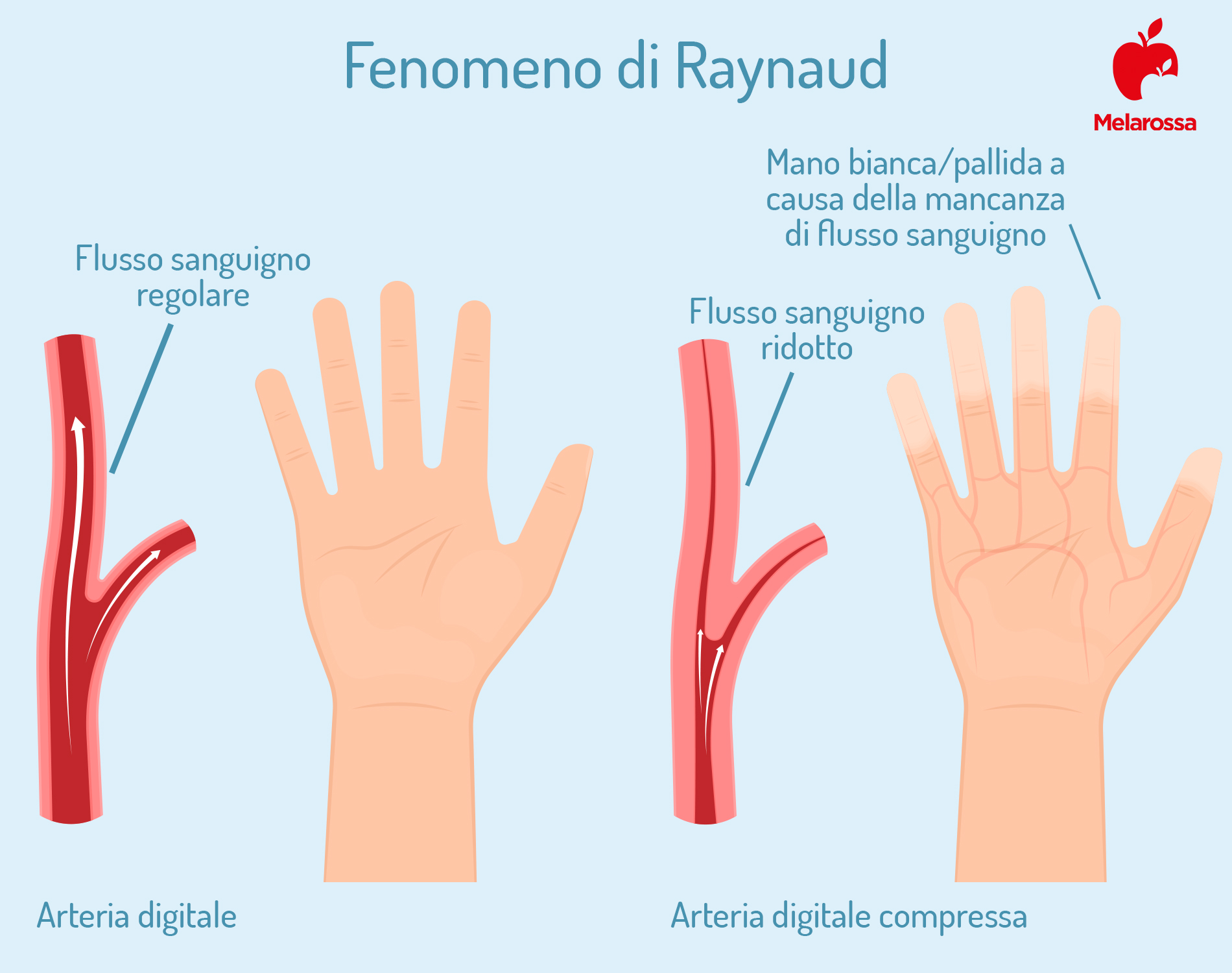Sclerodermia: cos’è, cause, sintomi, tipi, cure e prevenzione 1 sclerodermia: che cos'è