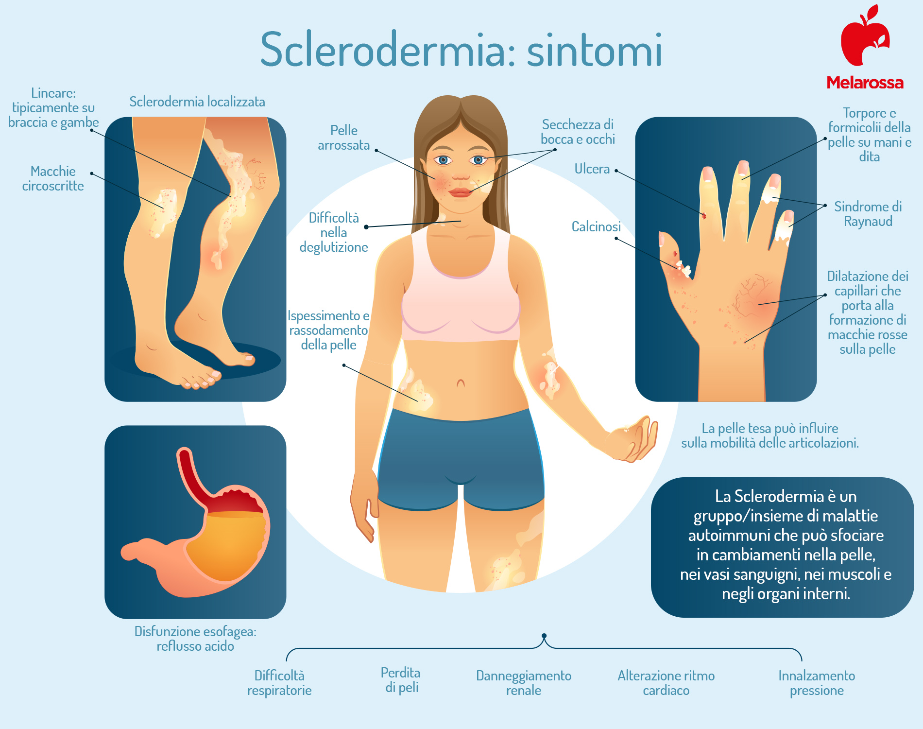 Sclerodermia: cos’è, cause, sintomi, tipi, cure e prevenzione 4 sclerodermia: sintomi