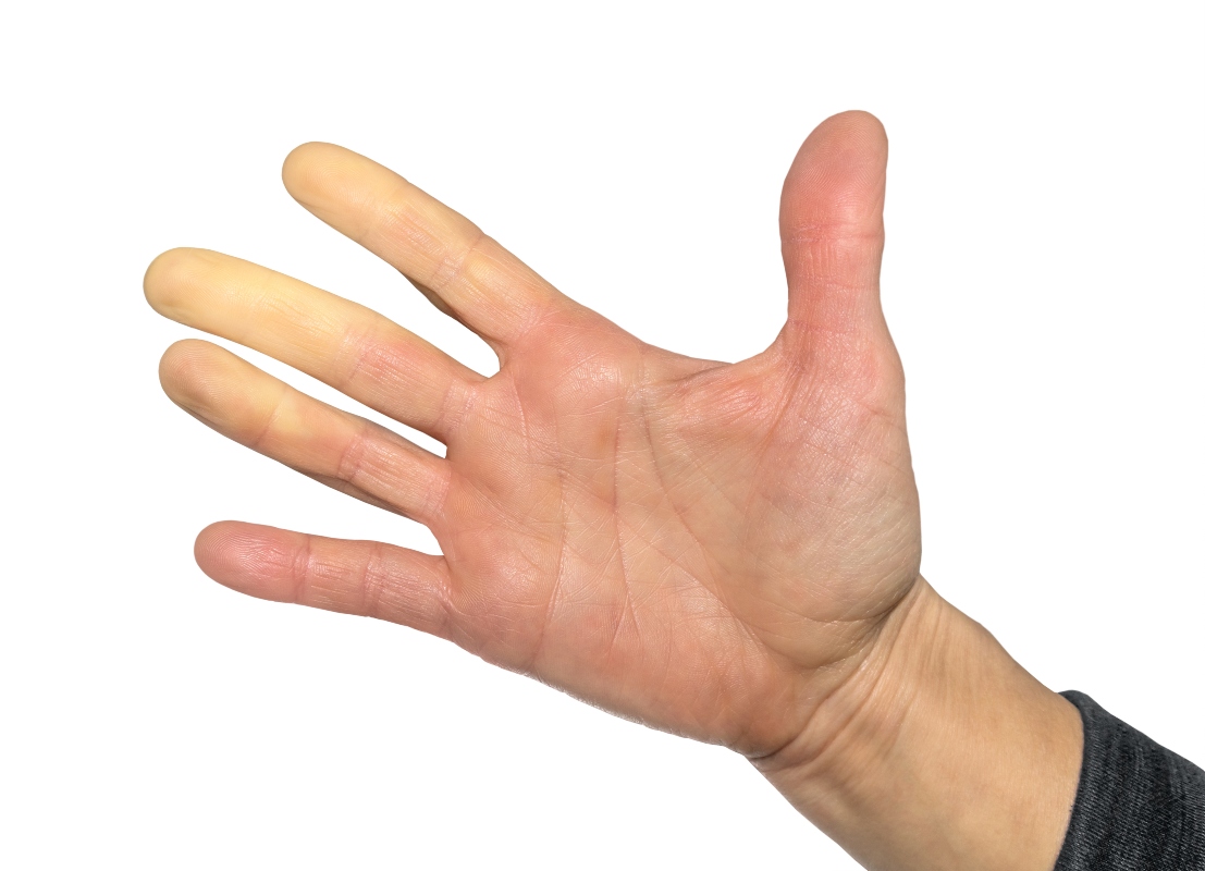 Sclerodermia: cos’è, cause, sintomi, tipi, cure e prevenzione 3 sclerodermia: tipi