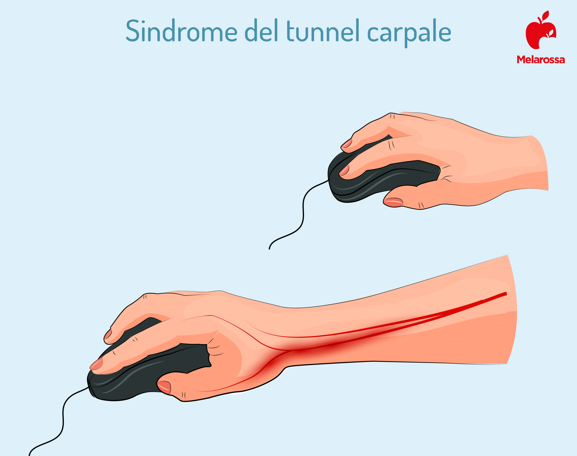 Sindrome del tunnel carpale: sintomi, rimedi ed esercizi per ridurre il dolore 2 sindrome del tunnel carpale: prevenzione