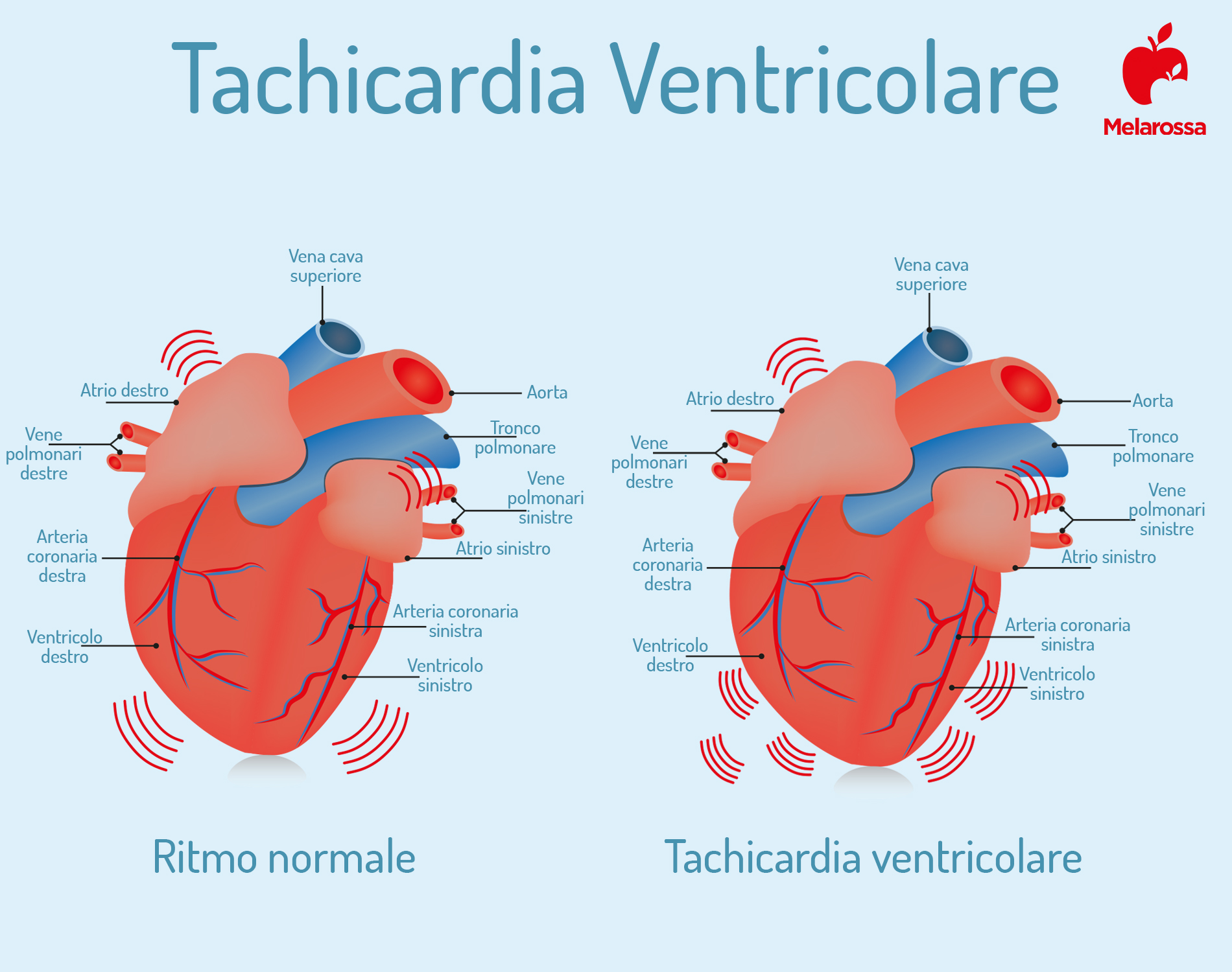 Tachicardia: cos'è, cause, sintomi, terapia e prevenzione 3 tachicardia ventricolare: che cos'è