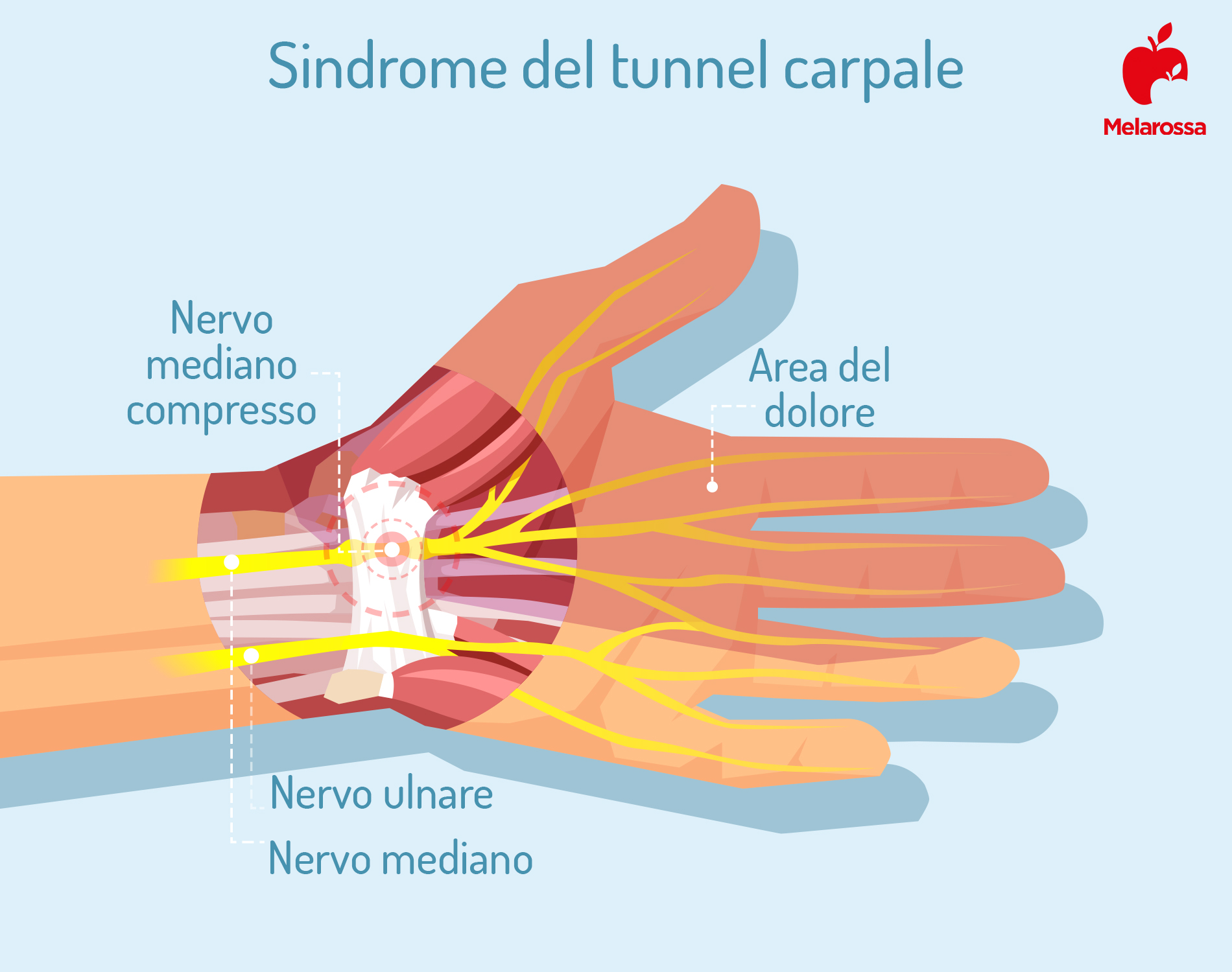 Sindrome del tunnel carpale: sintomi, rimedi ed esercizi per ridurre il dolore 1 sindrome del tunnel carpale: che cos'è