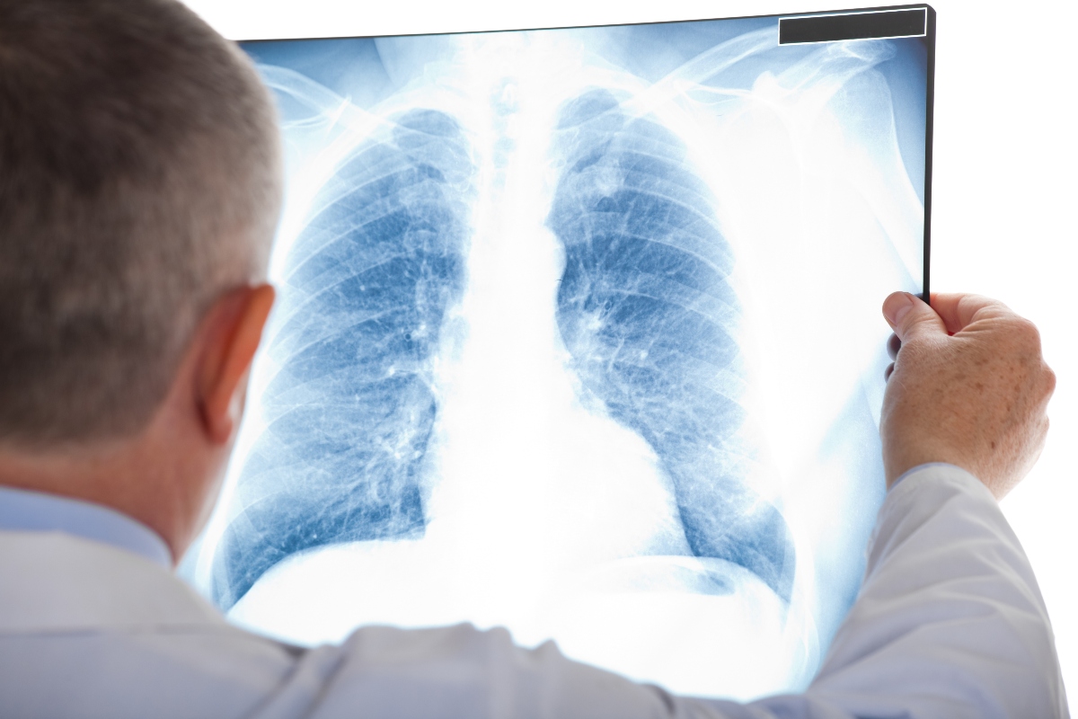Bronchiectasie: cosa sono, cause, sintomi, diagnosi, cure e trattamenti, prevenzione 4 Bronchiectasie: diagnosi