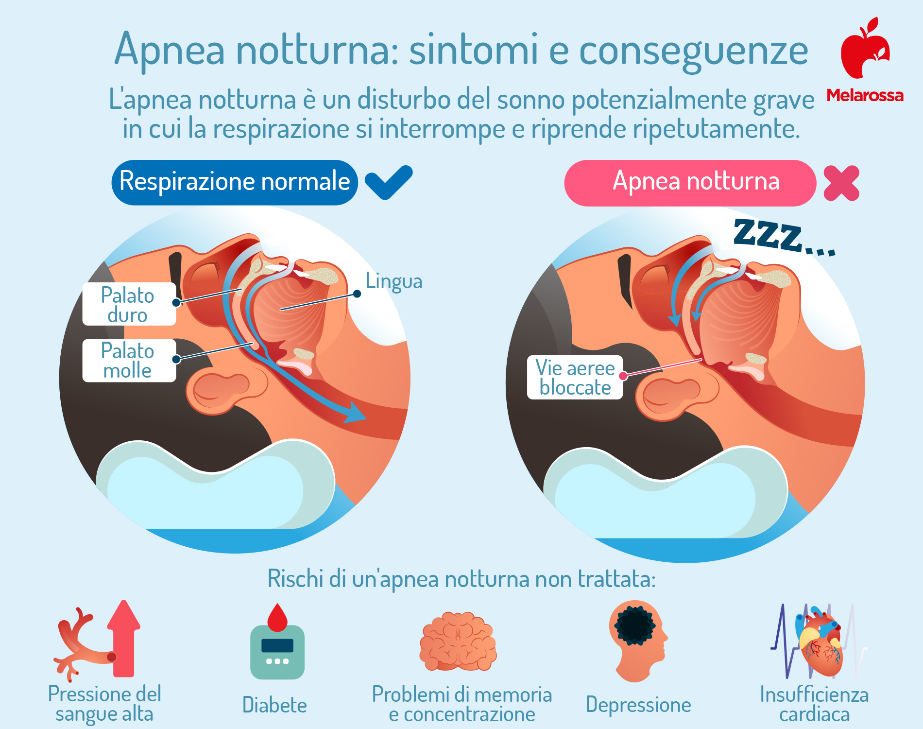 Apnea notturna: cos'è, cause, sintomi, conseguenze, cure e trattamenti 3 apnea notturna: sintomi e conseguenze