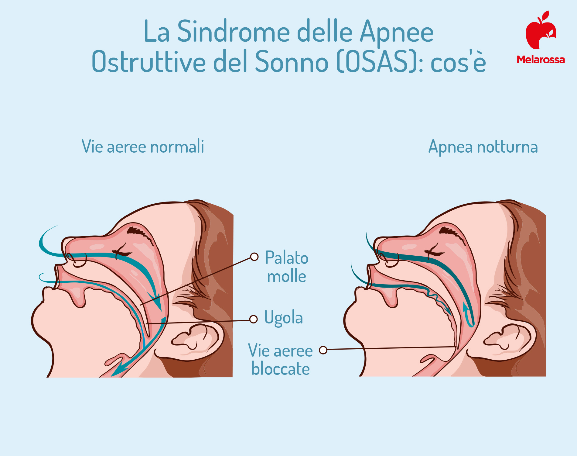 Apnea notturna: cos'è, cause, sintomi, conseguenze, cure e trattamenti 1 apnea notturna: cos'è