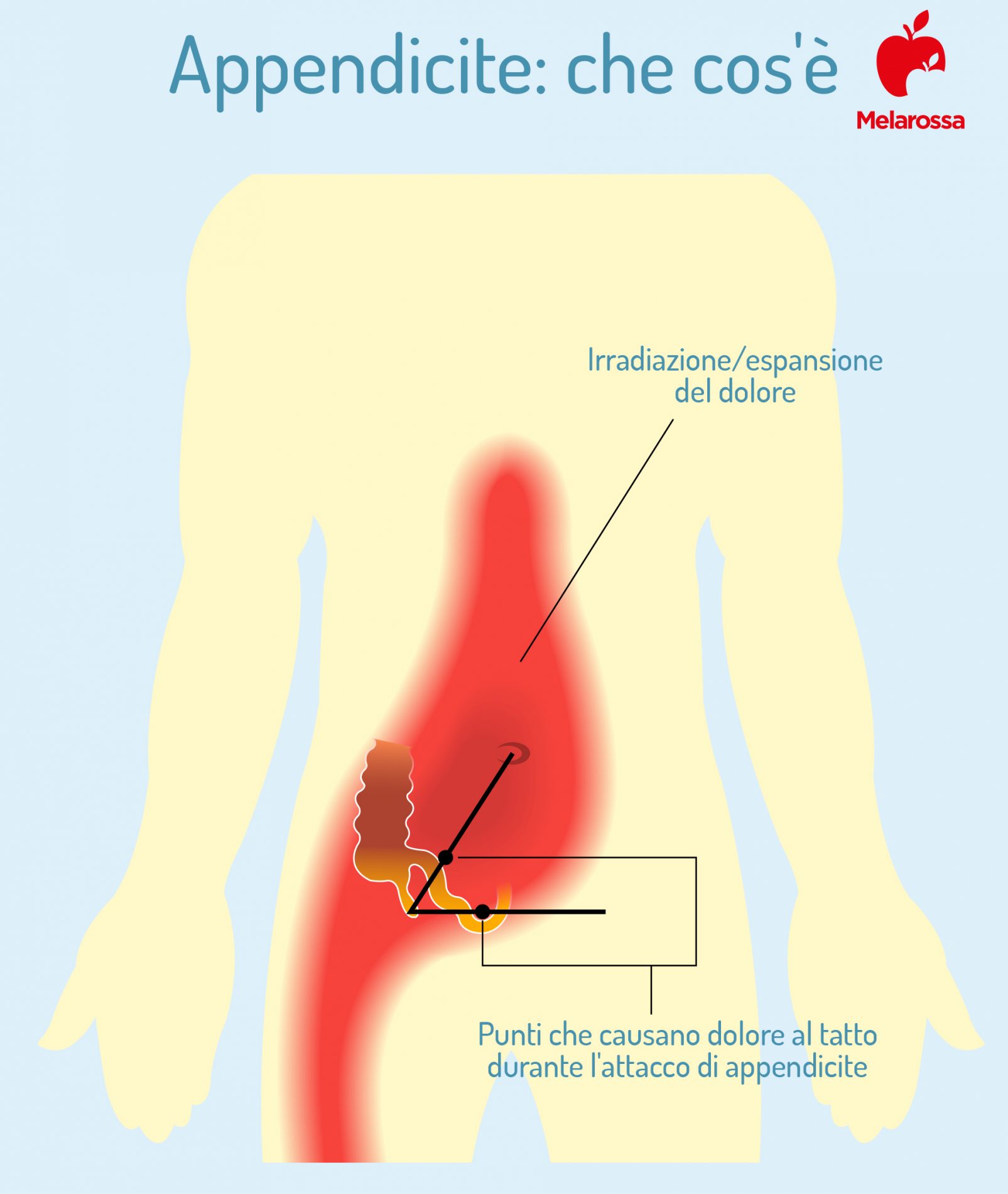 Appendicite: che cos’è, sintomi, epidemiologia, cause e trattamenti 1 appendicite: cos'è