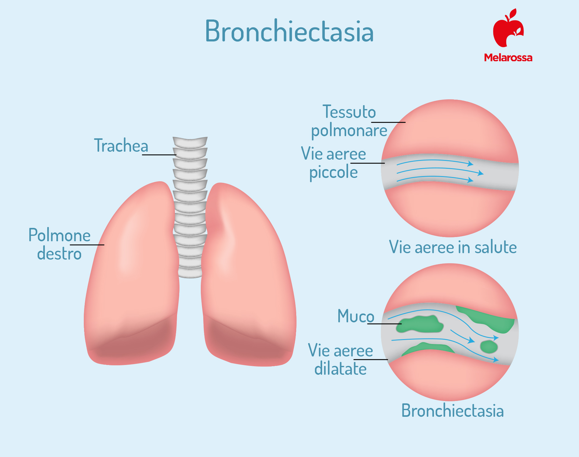 Bronchiectasie: cosa sono, cause, sintomi, diagnosi, cure e trattamenti, prevenzione 1 bronchiectasie: cosa sono