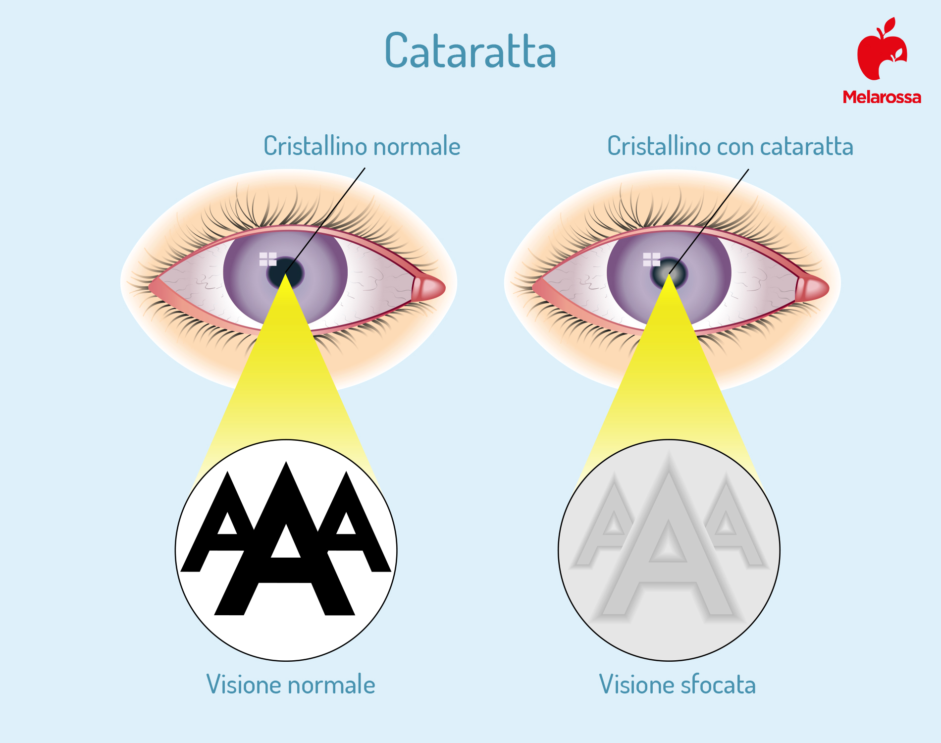 Cataratta: cos'è, cause, sintomi e fattori di rischio, cure e prevenzione 2 cataratta: cosa succede all'occhio