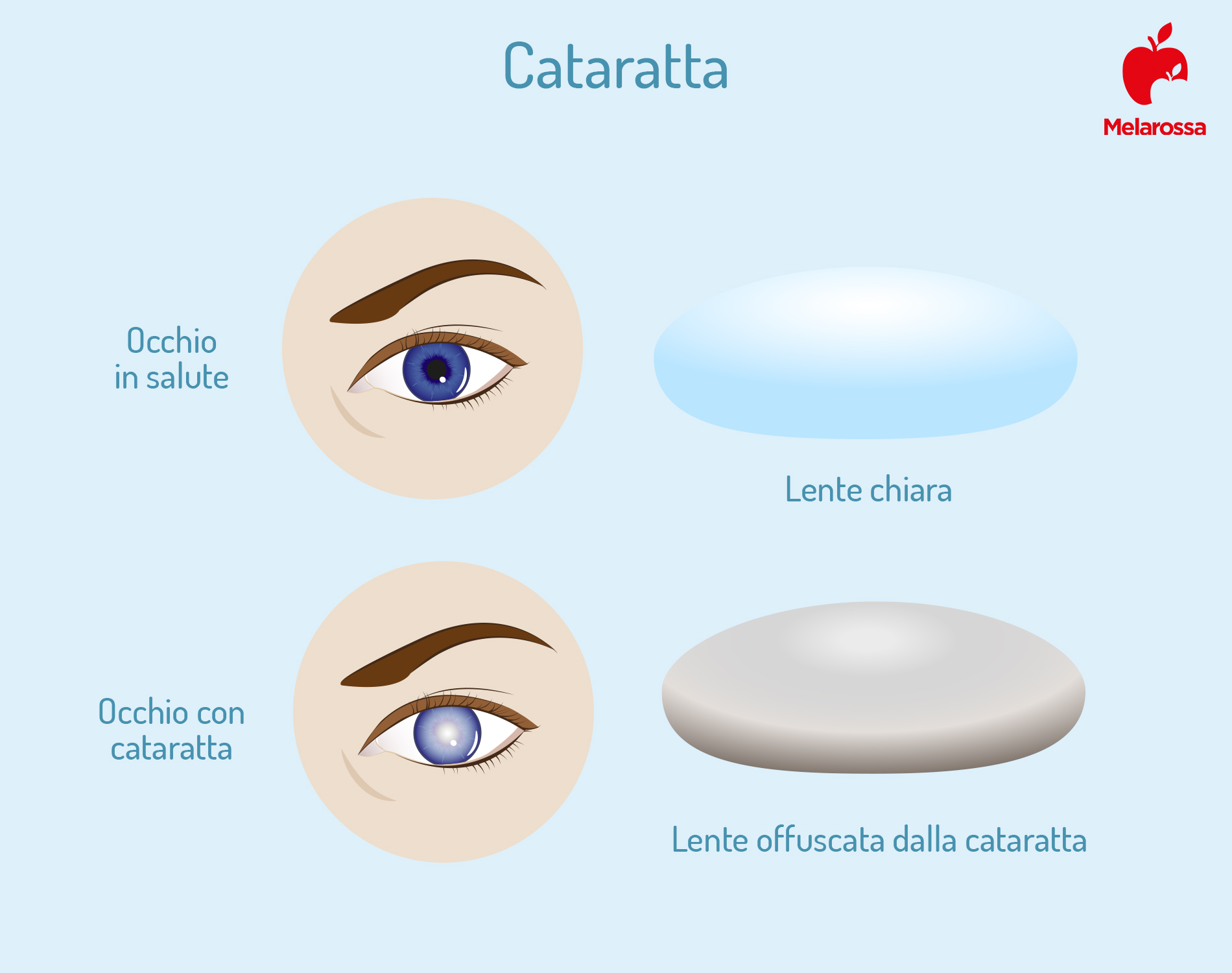 Cataratta: cos'è, cause, sintomi e fattori di rischio, cure e prevenzione 5 cataratta: sintomi