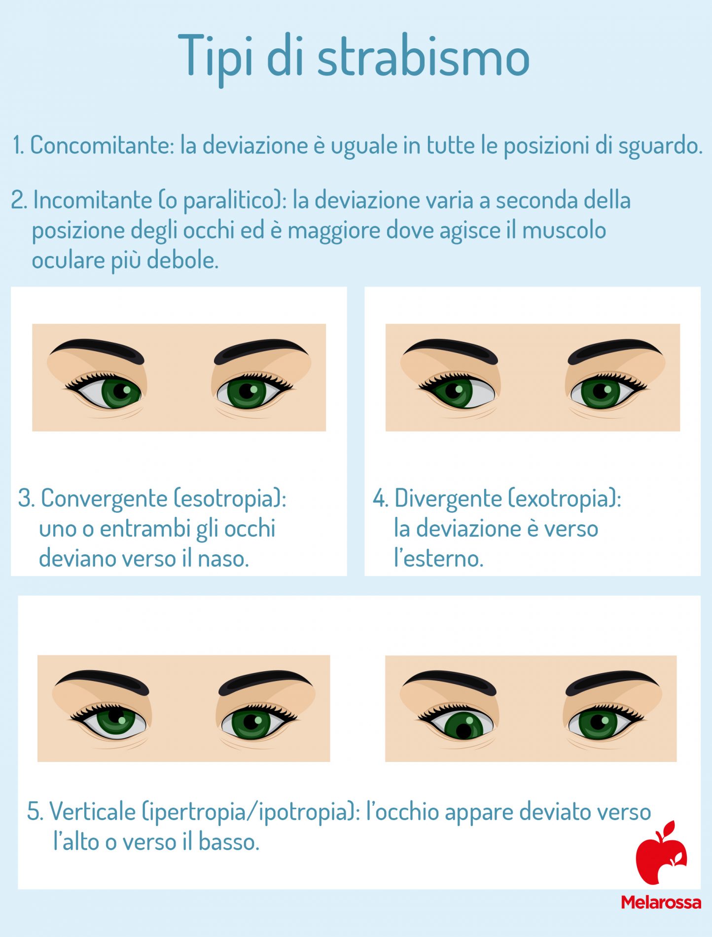 Strabismo: cos’è, tipologie, cause, sintomi, diagnosi e trattamento 1 tipi di strabismo