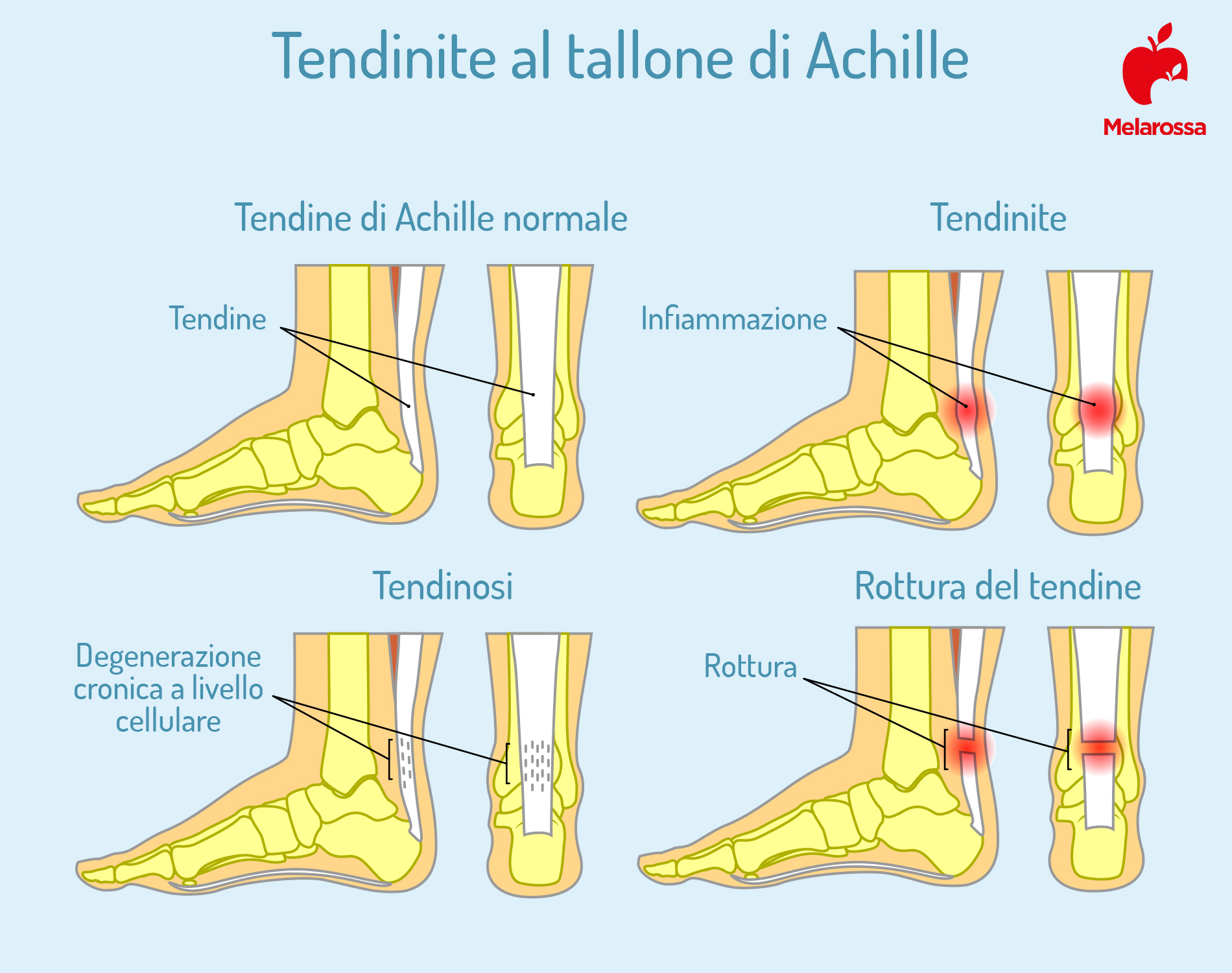 Tendinite: cos'è, sintomi, cause e cure 1 una grafica sulla tendinite al tallone di Achille