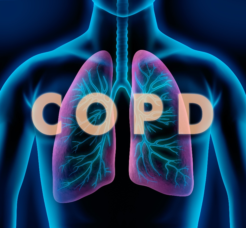 Broncopneumopatia cronica ostruttiva (BPCO): cos’è, sintomi, cause, diagnosi, conseguenze e cure 2 Broncopneumopatia cronica ostruttiva: cosa colpisce