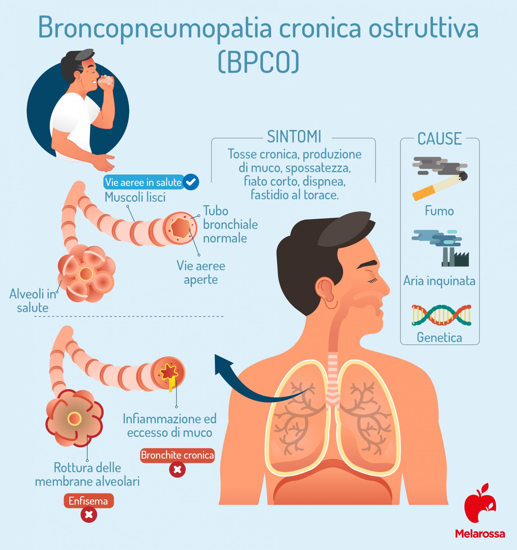 Broncopneumopatia cronica ostruttiva (BPCO): cos’è, sintomi, cause, diagnosi, conseguenze e cure 3 Broncopneumopatia cronica ostruttiva: cause e sintomi