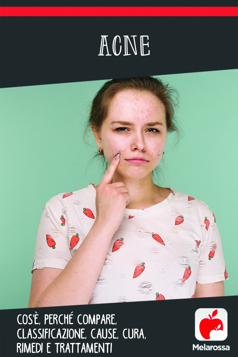Acne: cos'è, perché compare, classificazione, cause, cura, rimedi e trattamenti 13 acne: cause, sintomi, tipi, cure e prevenzione