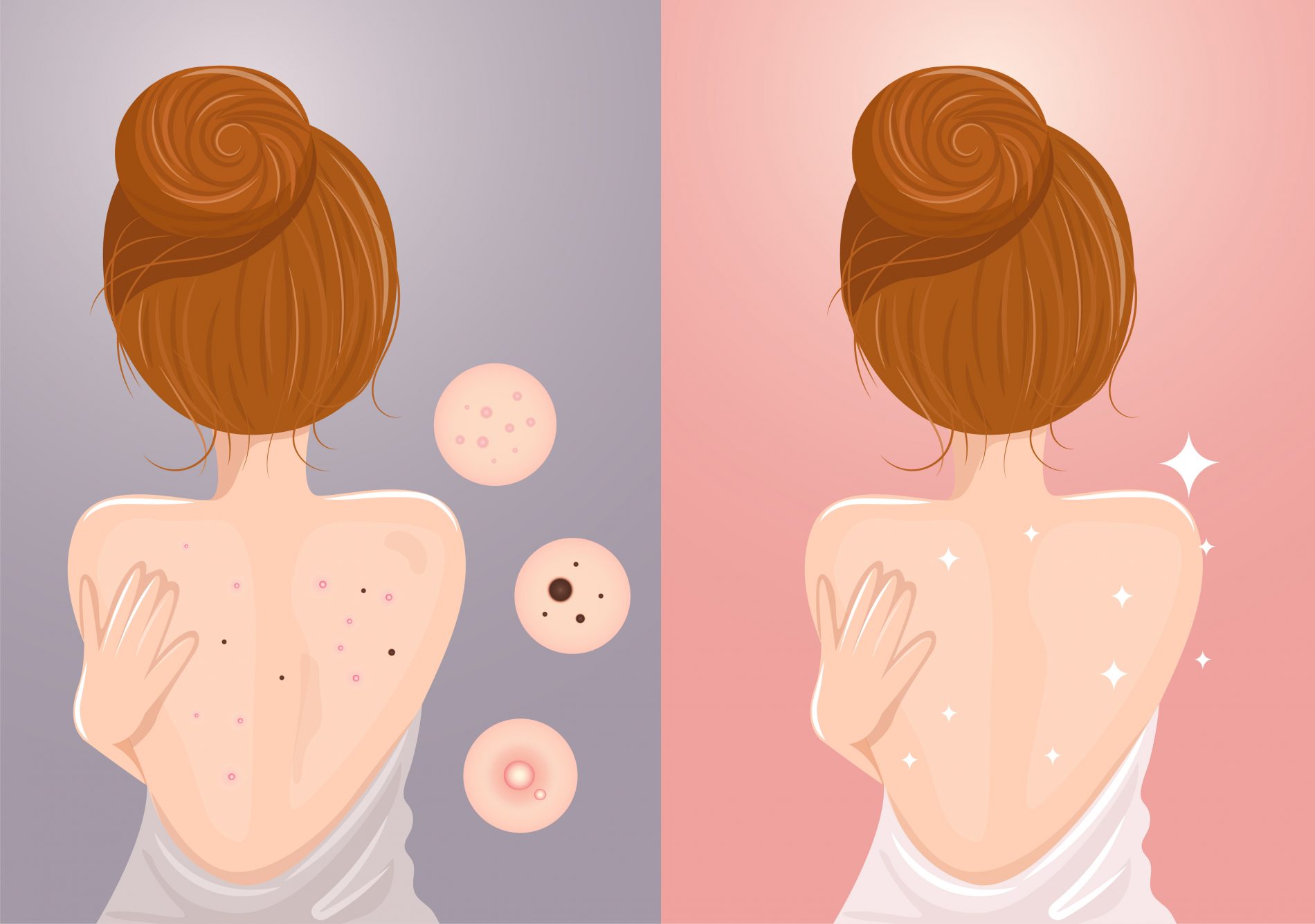 Acne: cos'è, perché compare, classificazione, cause, cura, rimedi e trattamenti 5 acne: cause