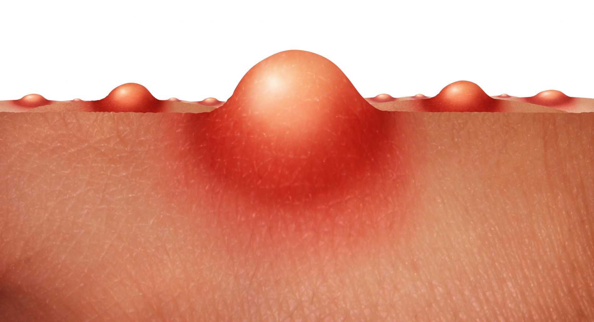 Acne: cos'è, perché compare, classificazione, cause, cura, rimedi e trattamenti 2 acne: pelle