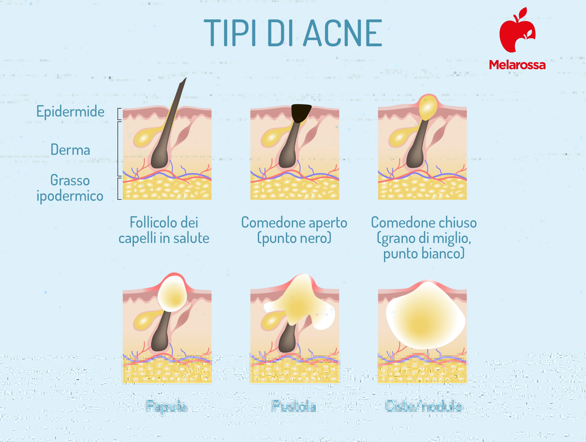 Acne: cos'è, perché compare, classificazione, cause, cura, rimedi e trattamenti 6 acne: tipi