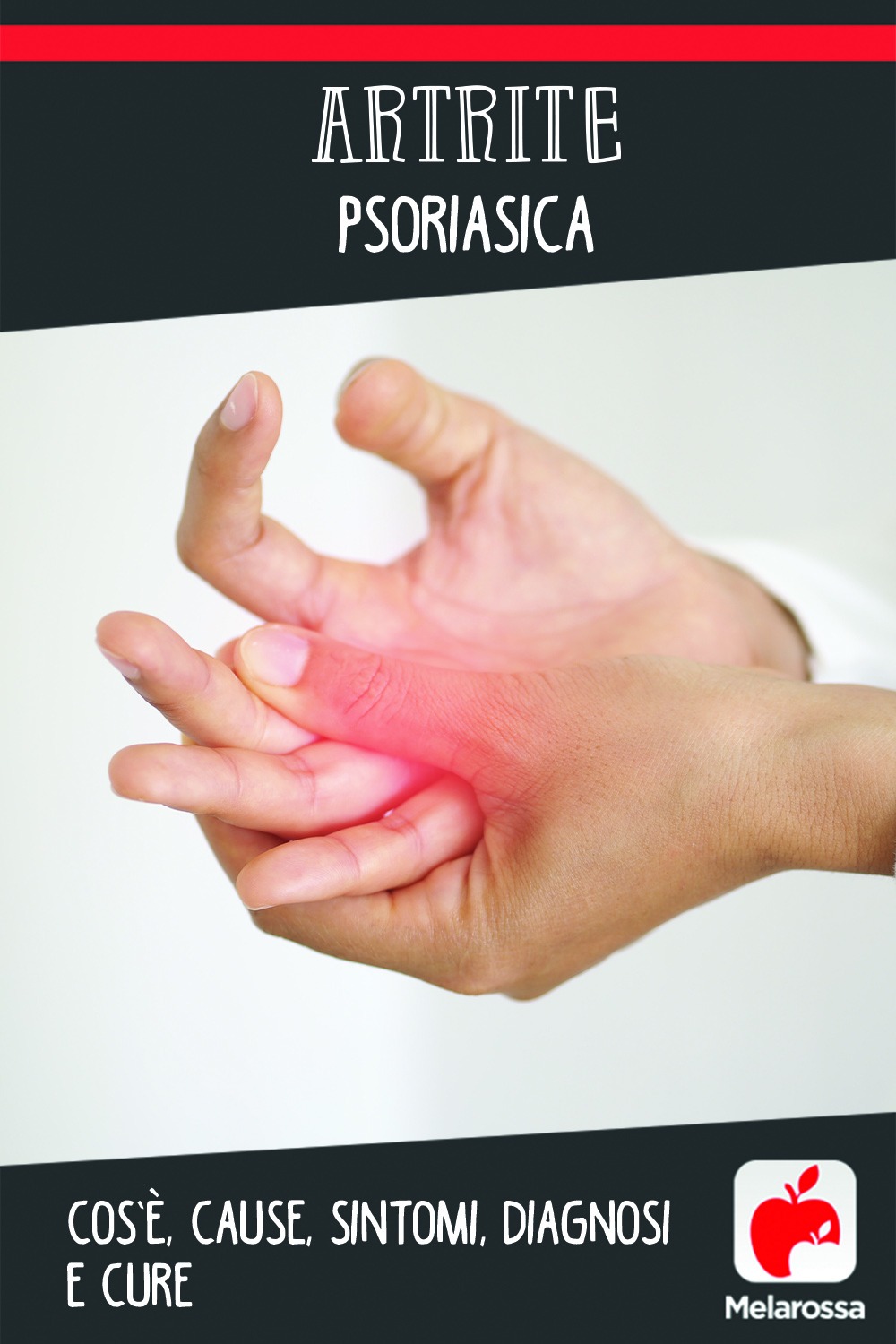 Artrite psoriasica: cos’è, cause, sintomi, diagnosi e cure 6 artrite psoriasica: cos'è, cause, sintomi, cure