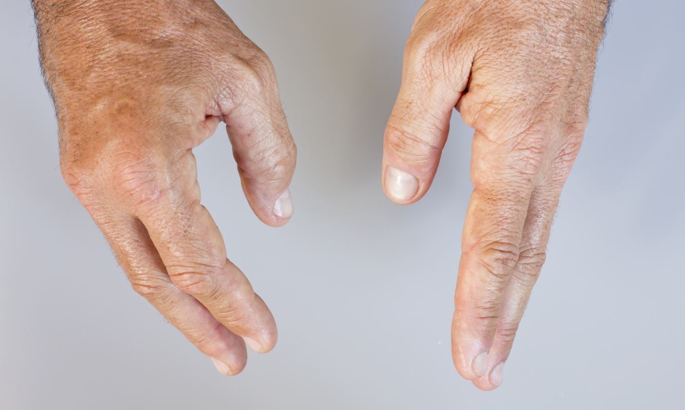 Artrite psoriasica: cos’è, cause, sintomi, diagnosi e cure 2 artrite psoriasica: dattilite
