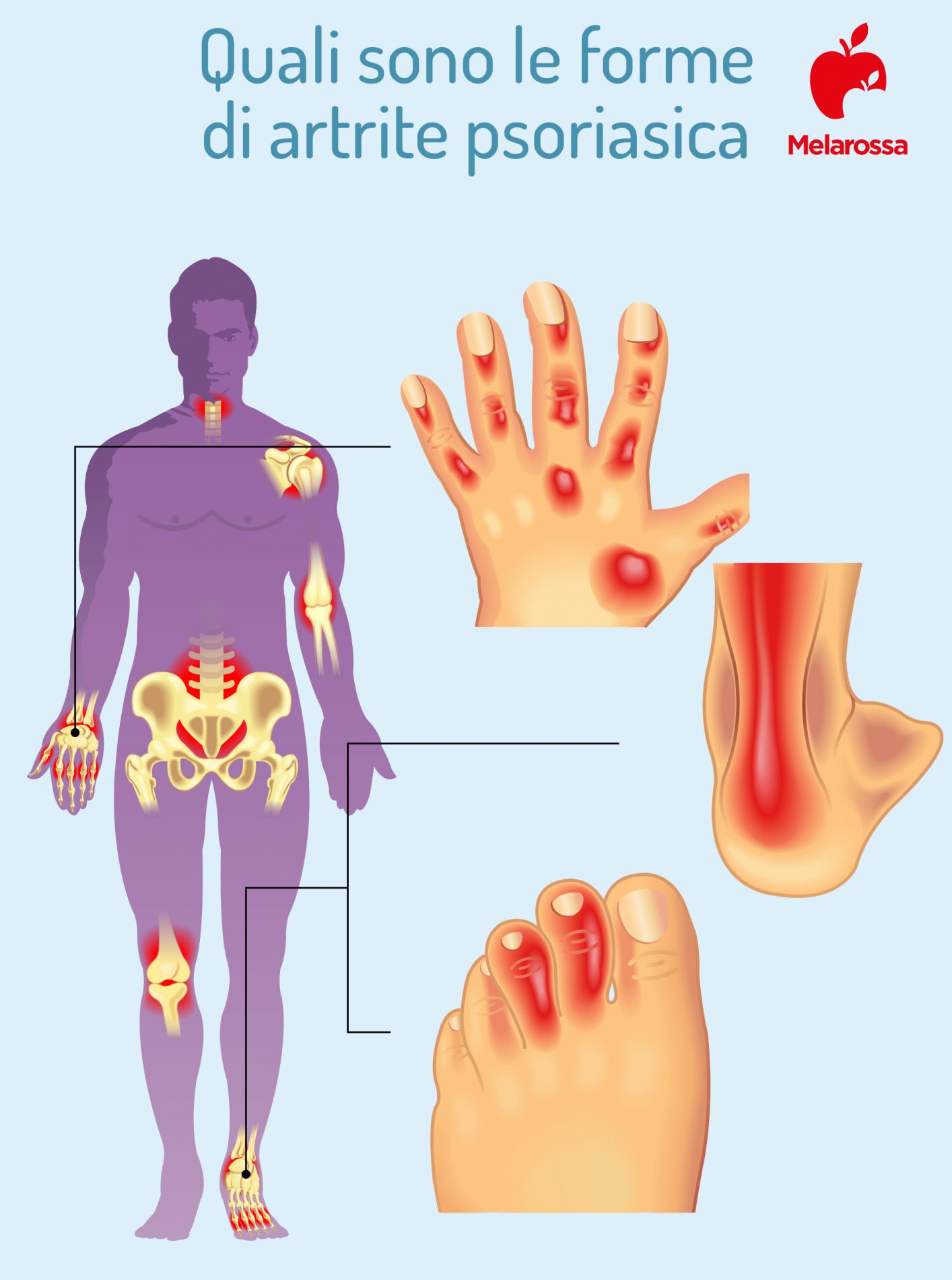 Artrite psoriasica: cos’è, cause, sintomi, diagnosi e cure 1 artrite psoriasica: forme
