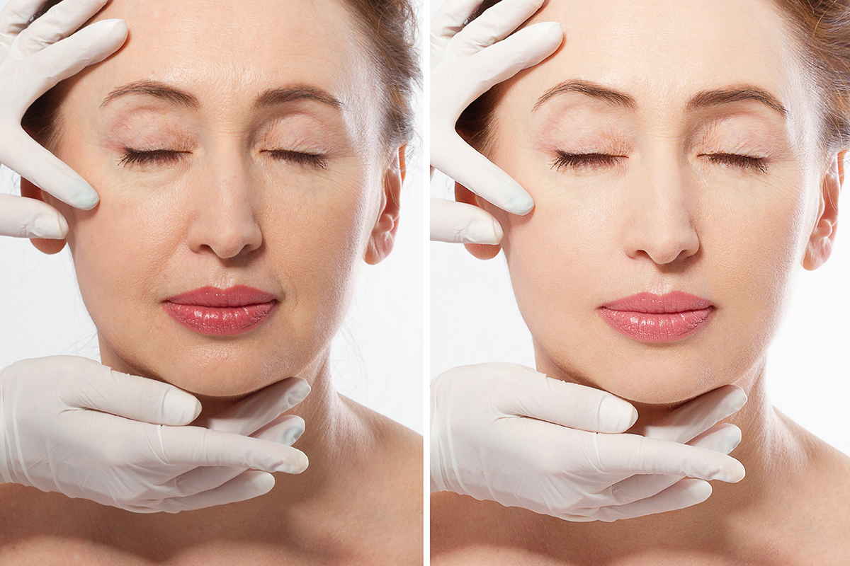 Borse sotto gli occhi: cosa sono, cause e sintomi, i rimedi naturali e i possibili trattamenti estetici 1 Borse sotto gli occhi cosa sono