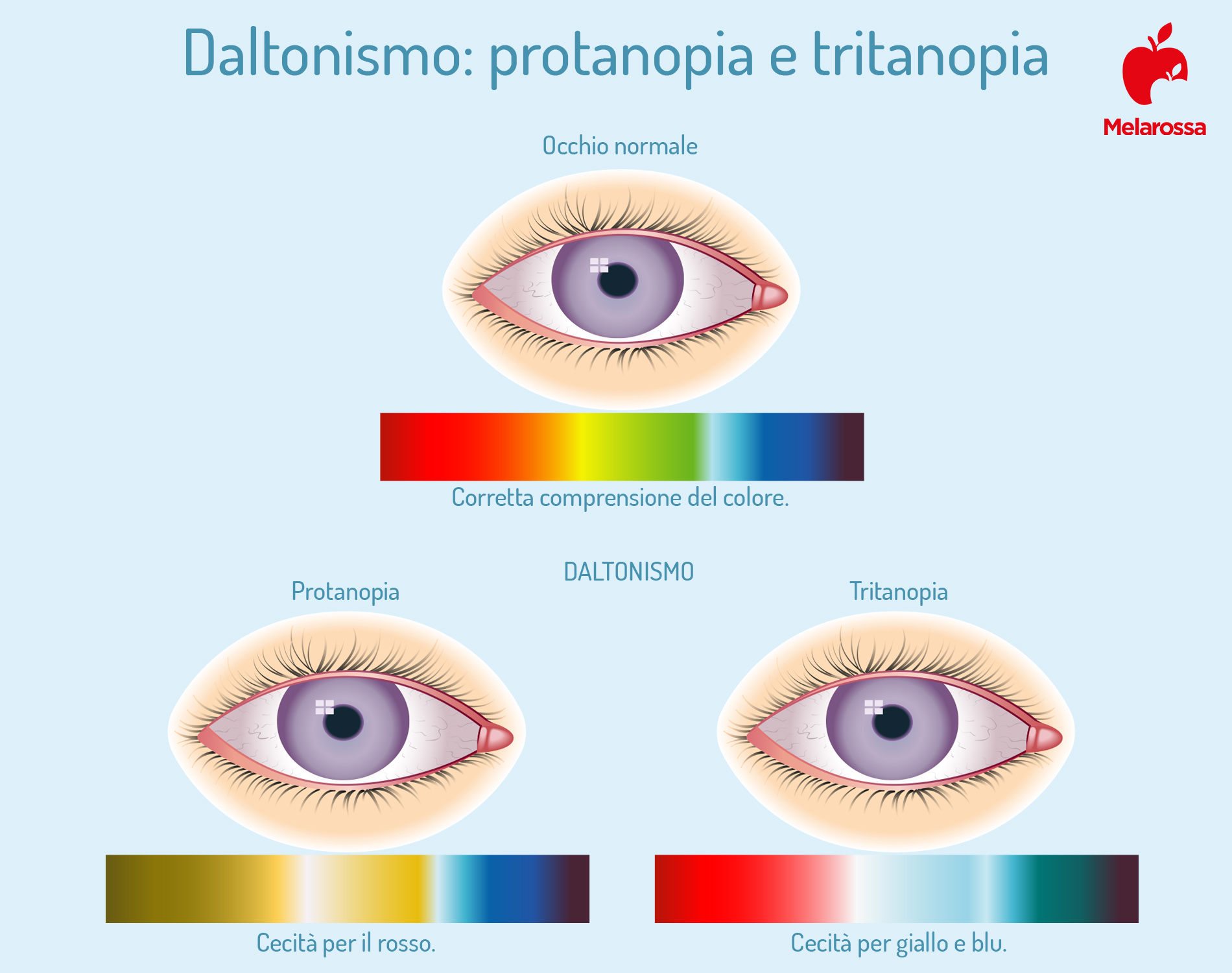 Daltonismo: cos’è, le diverse forme, cause, diagnosi e trattamento 4 daltonismo e colori
