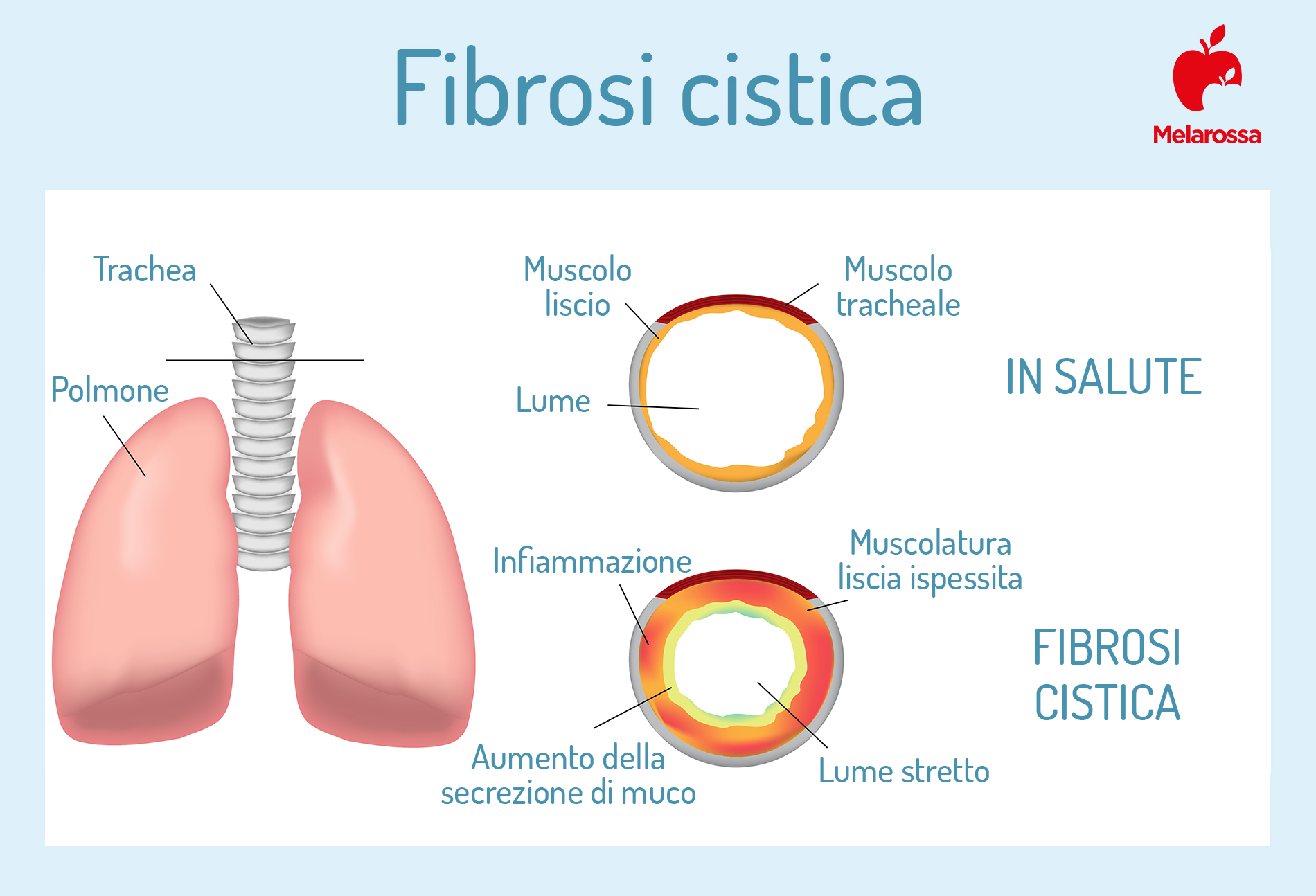 Fibrosi cistica: cos’è, cause, sintomi, come si manifesta, diagnosi, cure e trattamenti 3 fibrosi cistica: che cos'è
