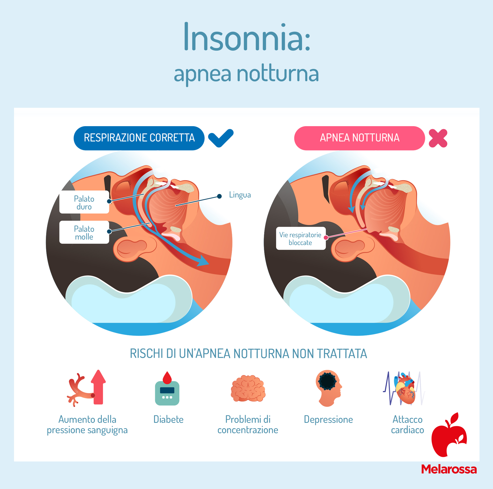 Insonnia: che cos'è, tipologie, cause, rimedi e conseguenza sulla salute 4 Insonnia e apnea notturna