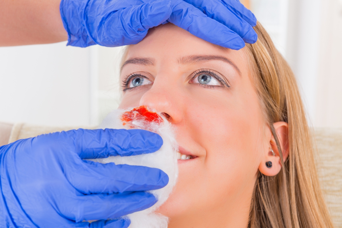 Sangue dal naso o epistassi: che cos’è, cause, sintomi, cure e trattamenti 4 sangue dal naso: cure e trattamenti