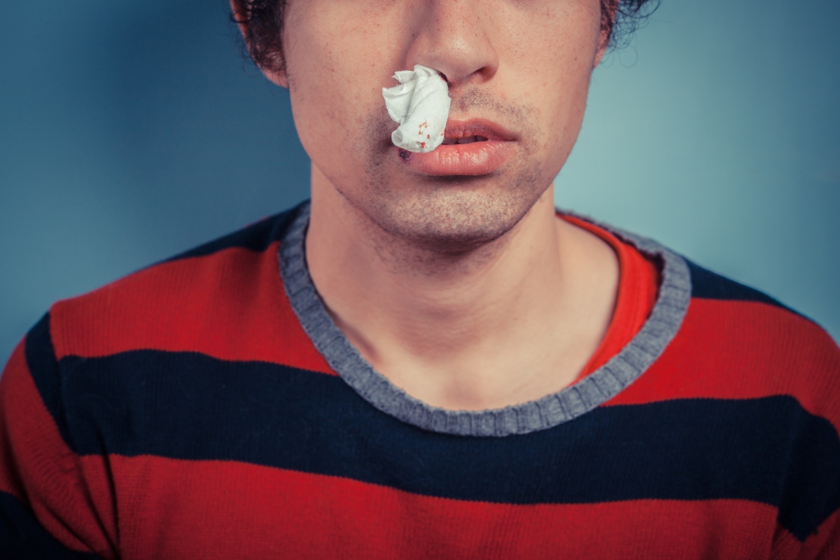 Sangue dal naso o epistassi: che cos’è, cause, sintomi, cure e trattamenti 1 sangue dal naso o epistassi: cos'è