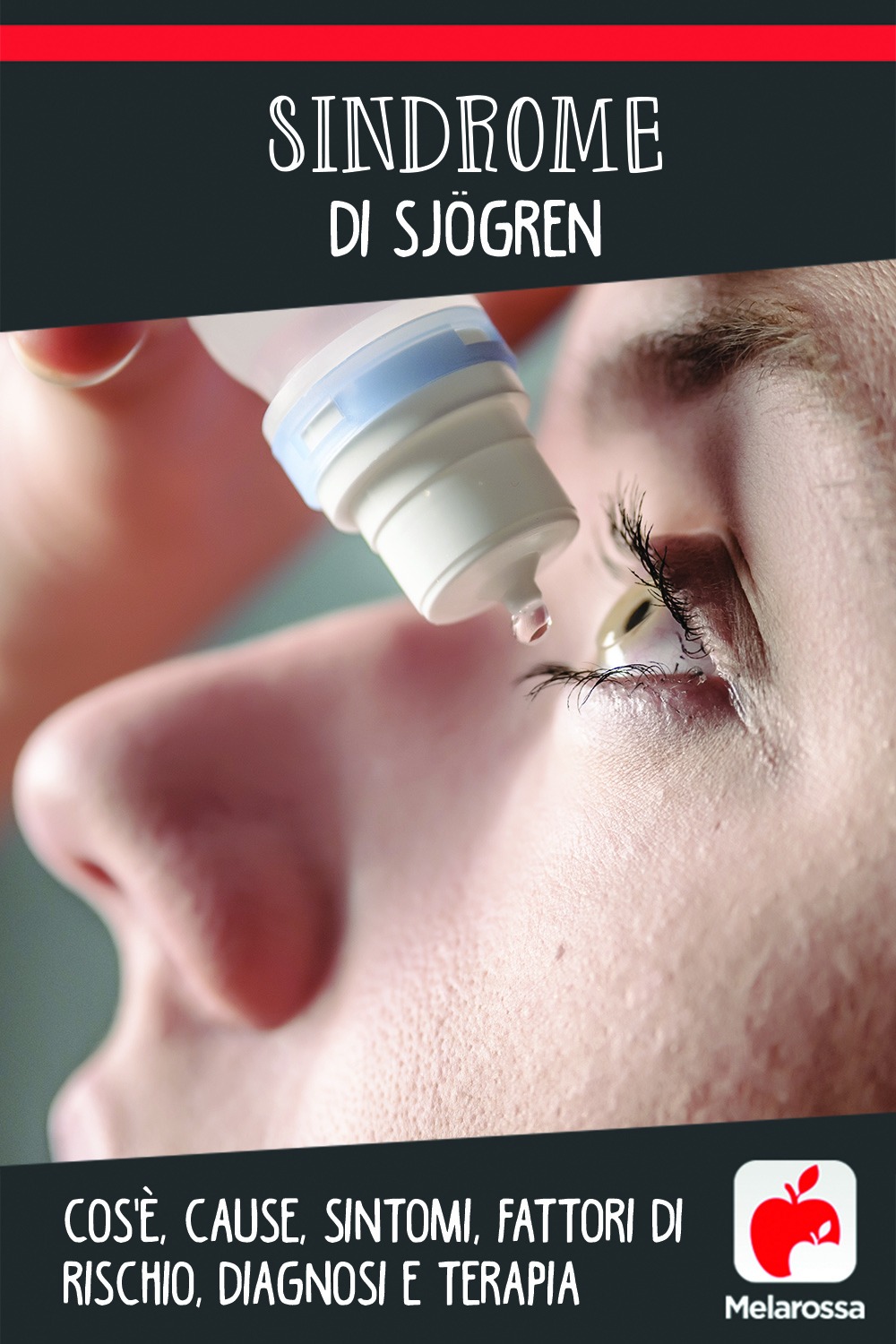 Sindrome di Sjögren: cos'è, cause, sintomi, fattori di rischio, diagnosi e terapia 5 Sindrome di Sjoren: cos'è, cause, sintomi e cure