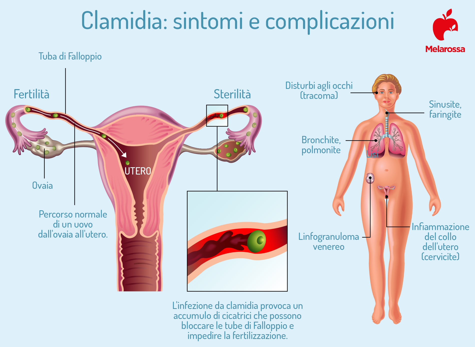 Clamidia: che cos’è, come si trasmette, sintomi cure e prevenzione 4 clamidia: sintomi