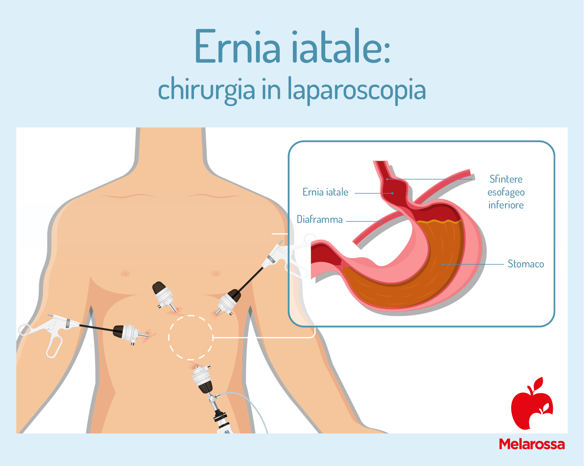 Ernia iatale: cos’è, quali sono i sintomi e come si cura 6 Ernia iatale: chirurgia in laparoscopia
