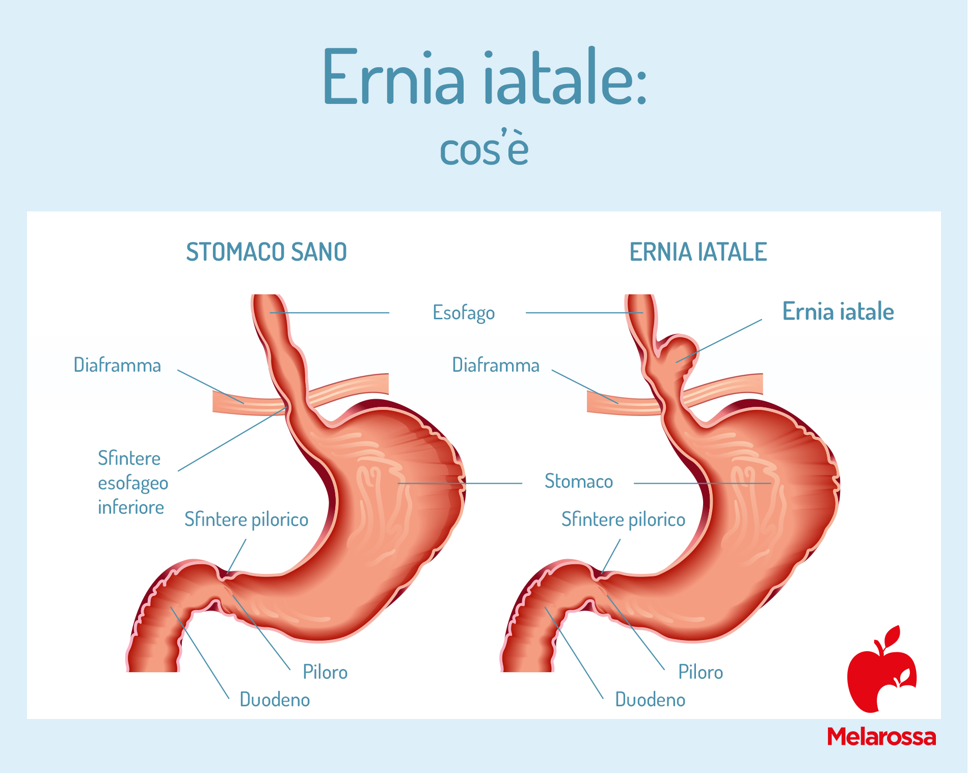 Ernia iatale: cos’è, quali sono i sintomi e come si cura 1 Cos'è l'ernia iatale.