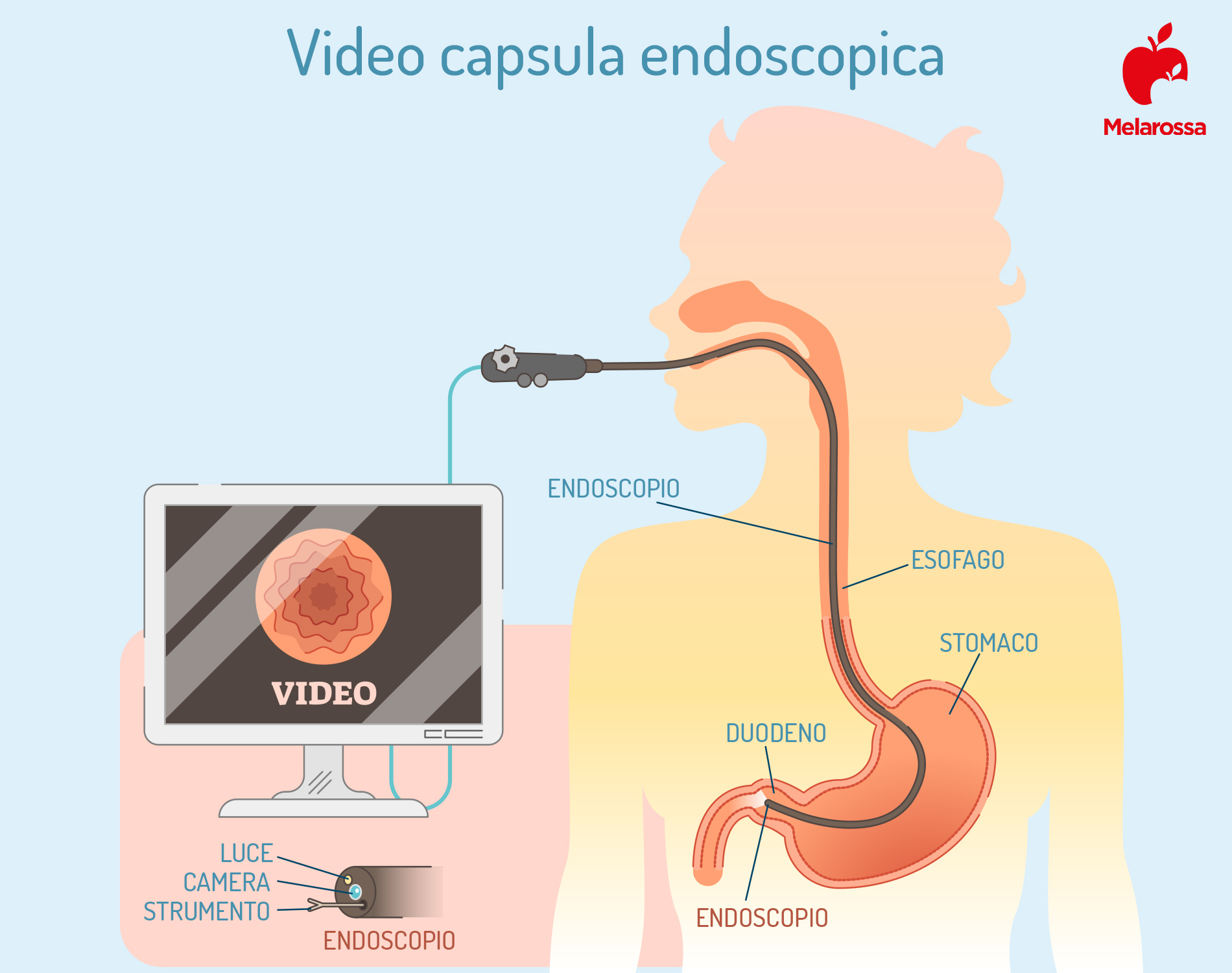 Gastroscopia: cos’è, come funziona, quando farla, come prepararsi all’esame, metodi alternativi, risultati 5 gastroscopia: video capsula endoscopia