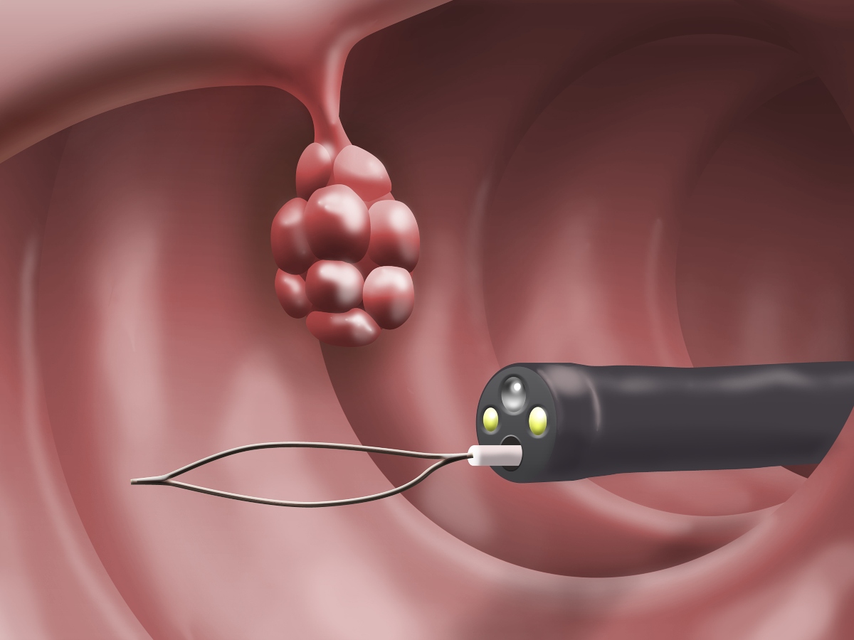 Gastroscopia: cos’è, come funziona, quando farla, come prepararsi all’esame, metodi alternativi, risultati 2 gastroscopia: rimozione polipi