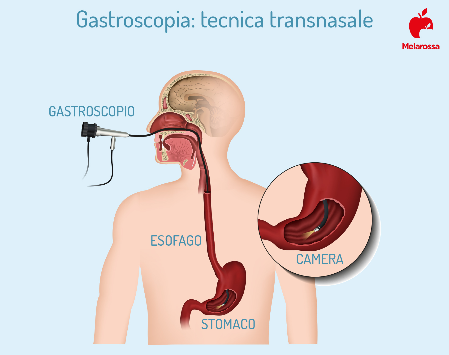Gastroscopia: cos’è, come funziona, quando farla, come prepararsi all’esame, metodi alternativi, risultati 4 gatsroscopia: tecnica transnasale