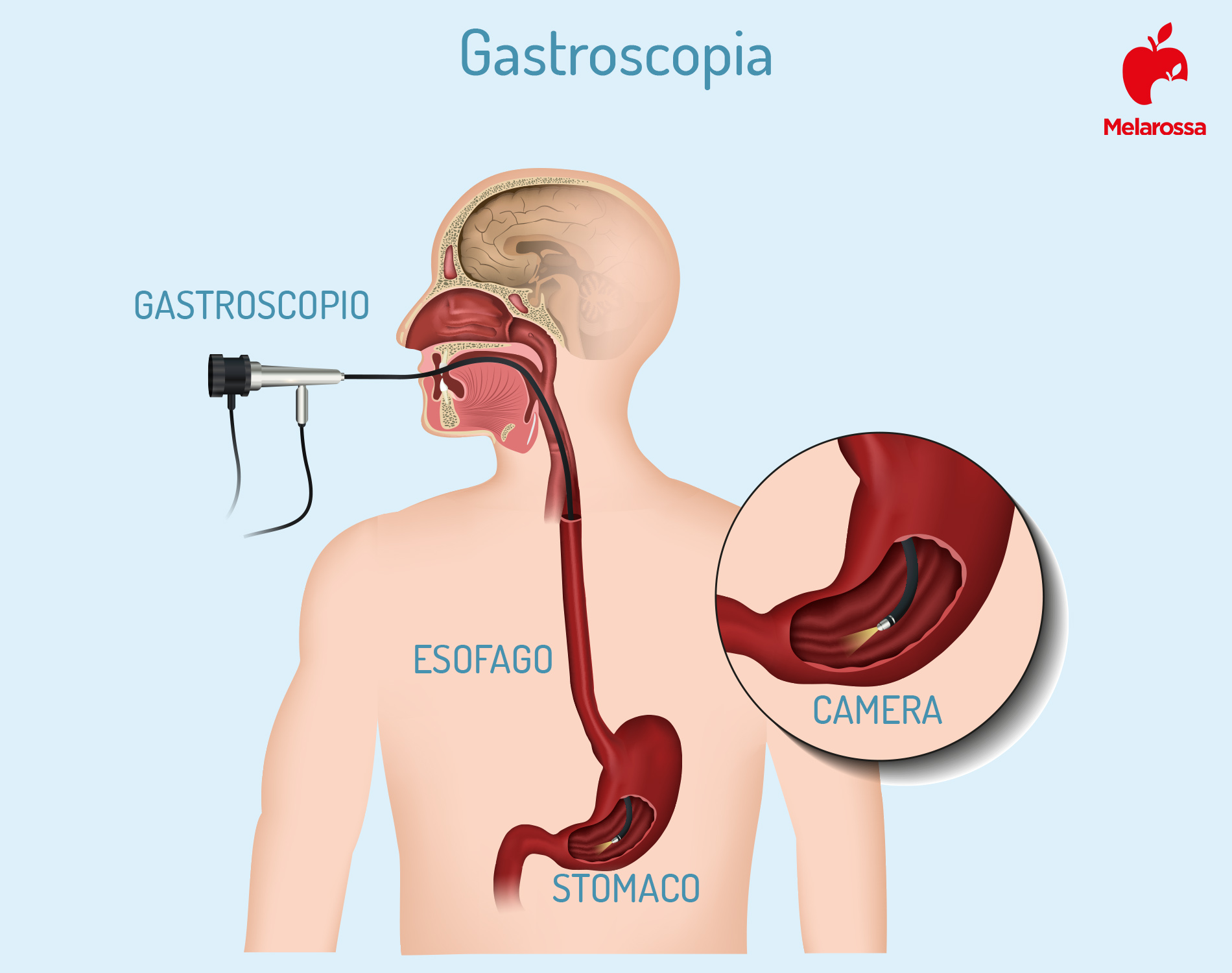 Gastroscopia: cos’è, come funziona, quando farla, come prepararsi all’esame, metodi alternativi, risultati 1 gastroscopia: che cos'è