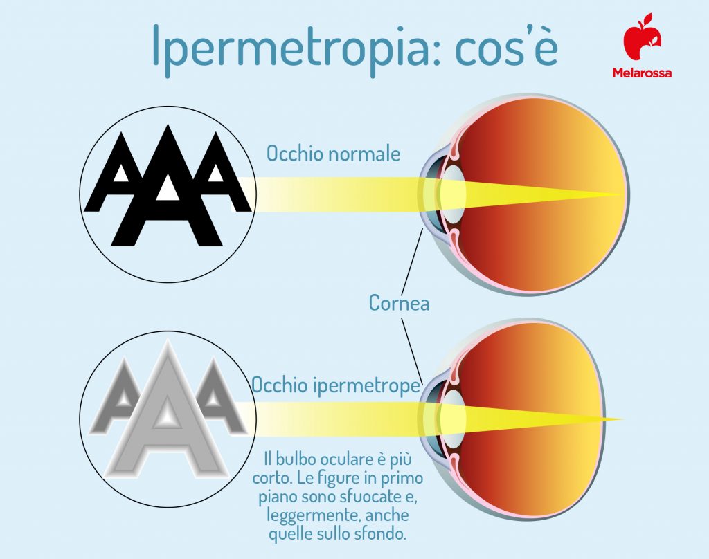 Ipermetropia: cos'è, cause, sintomi, fattori di rischio e cure 1 ipermetropia cos e 1