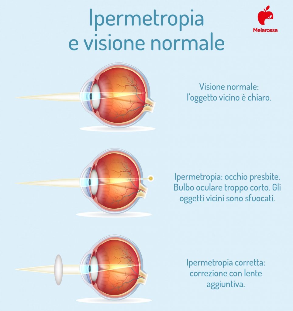 Ipermetropia: cos'è, cause, sintomi, fattori di rischio e cure 2 ipermetropia e visione normale 2