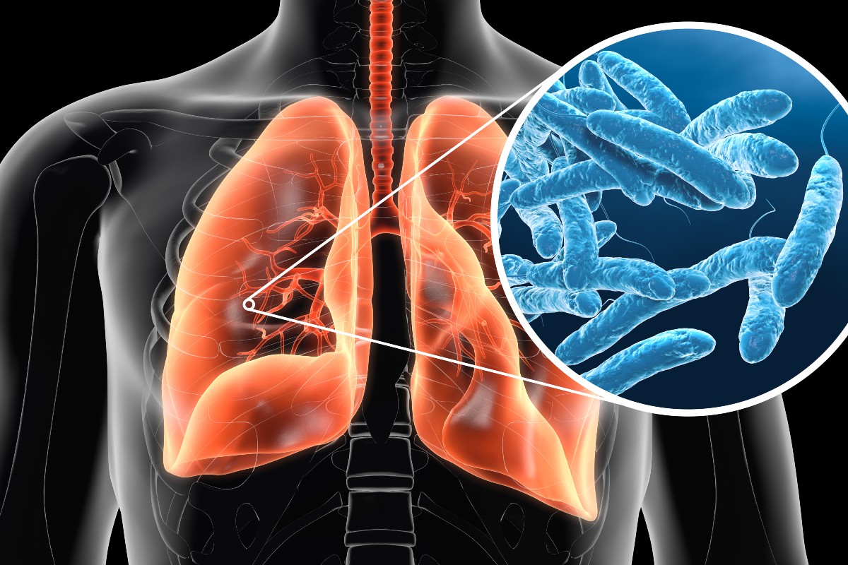 Legionella: cos’è, caratteristiche, contagio, sintomi, cure e prevenzione 2 legionella polmonite del legionario