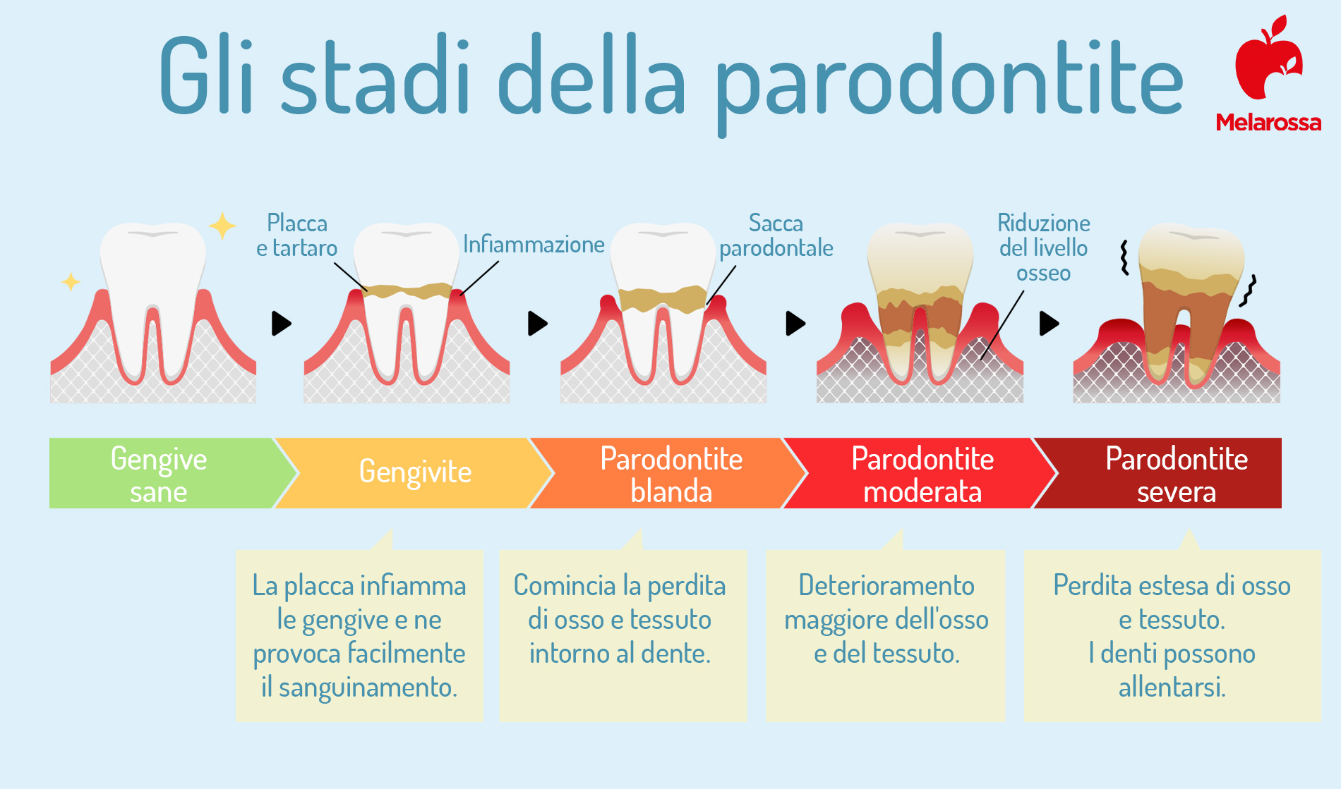 Parodontite: cos'è, cause, sintomi, cure e prevenzione 6 stadi della parodontite