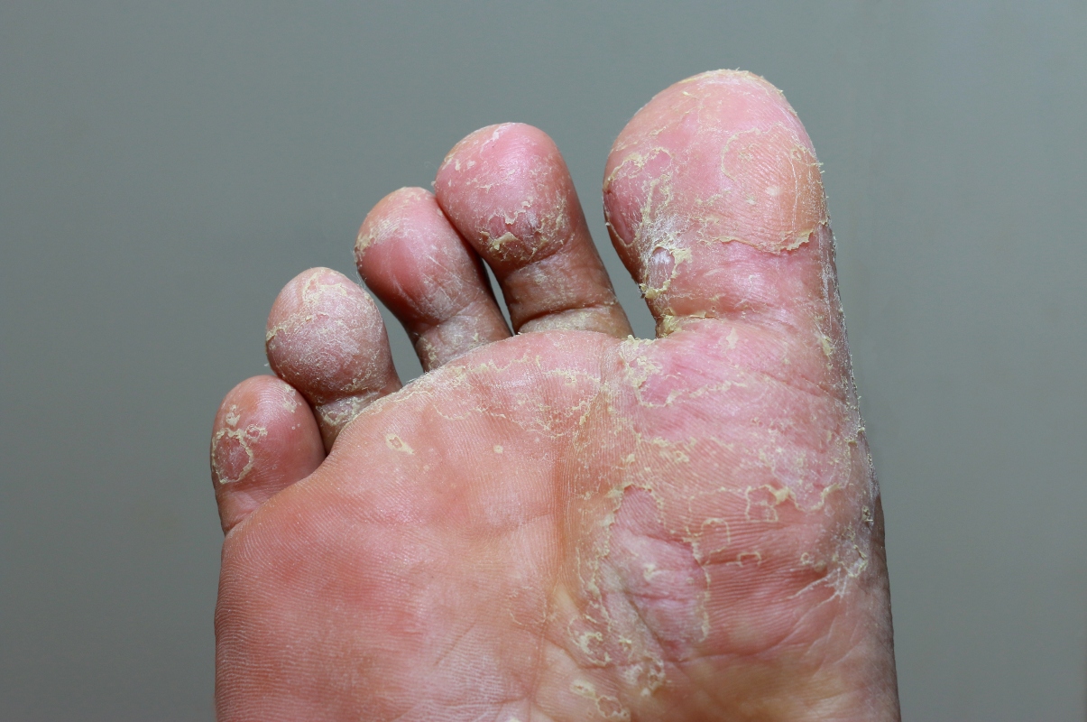 Piede d’atleta: cos’è, cause, sintomi, terapie e rimedi naturali, come prevenire 1 piede d'atleta o tigna del piede: immagine
